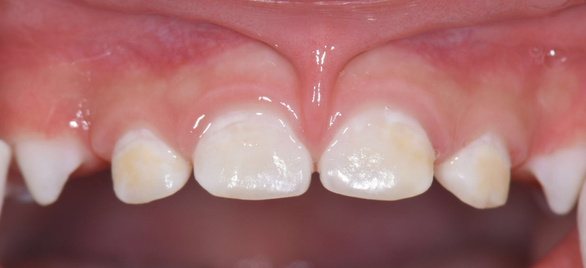 子供の歯にチョークのような白い部分があり歯磨きしても取れません。これは何でしょうか？