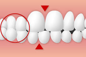 顔がゆがんできてしまう、子供の時に絶対治したほうがいい交叉咬合とは？