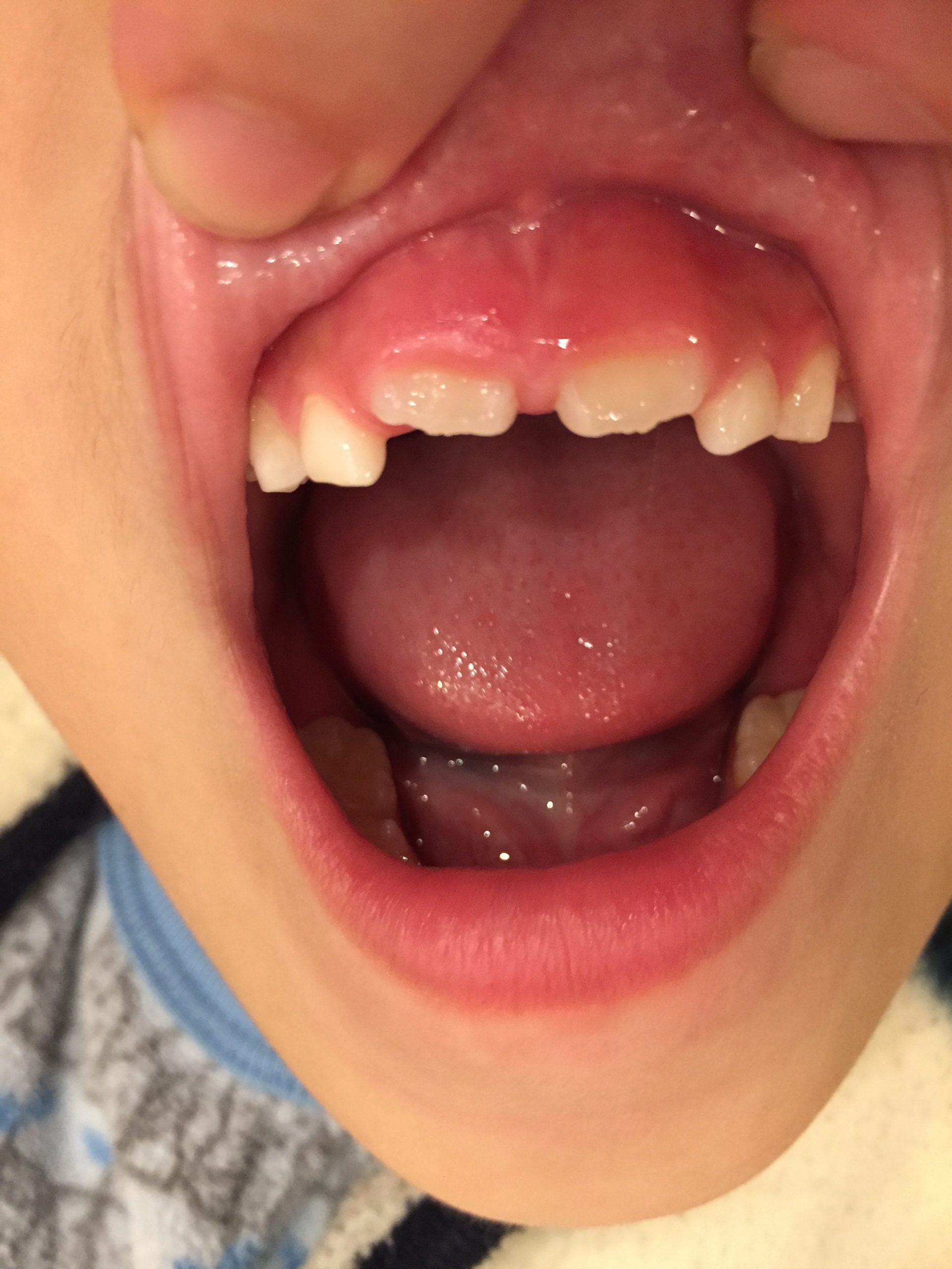 子供の上の前歯がすきっ歯ですが大丈夫ですか？