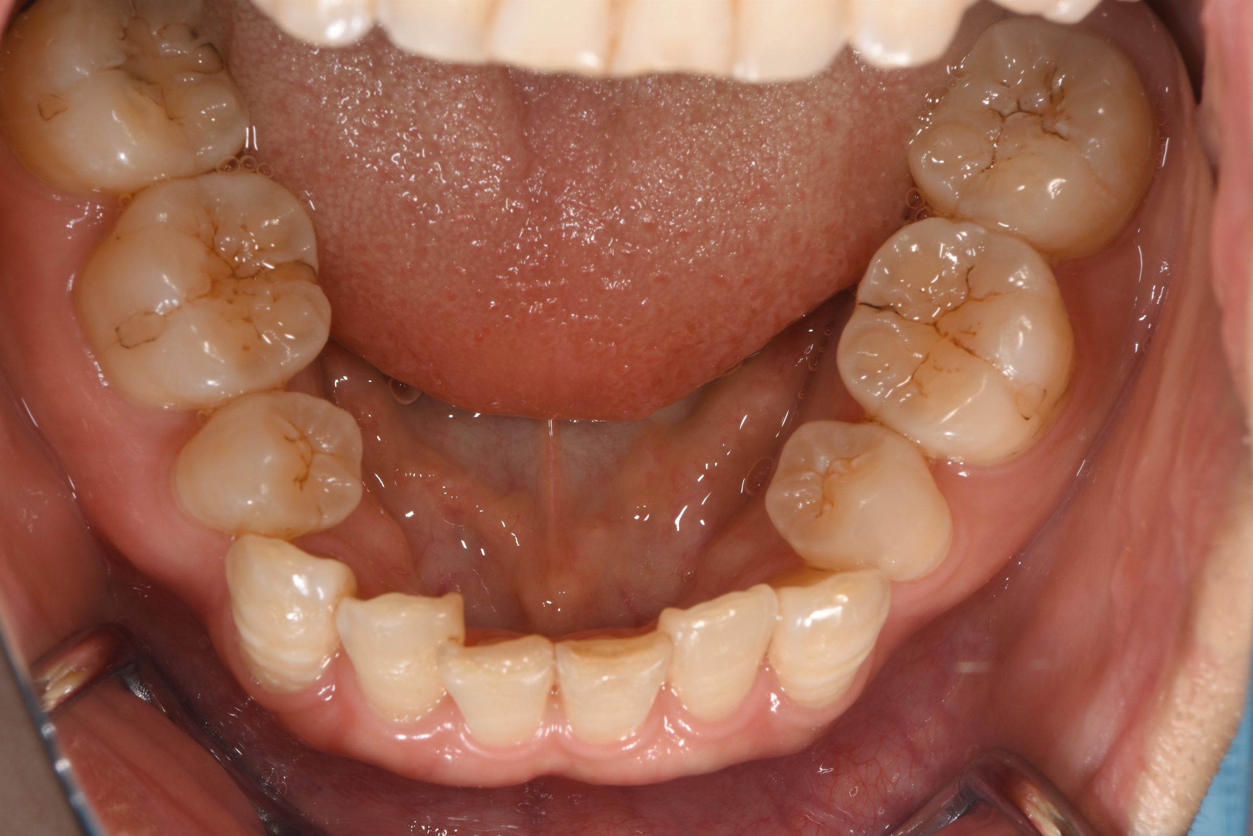 歯 と 歯 の 間 茶色 虫歯