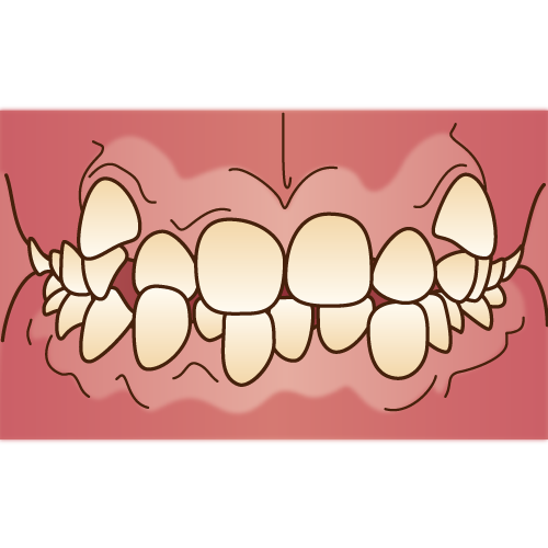 八重歯が可愛いと思ってるのは世界で日本だけ！？