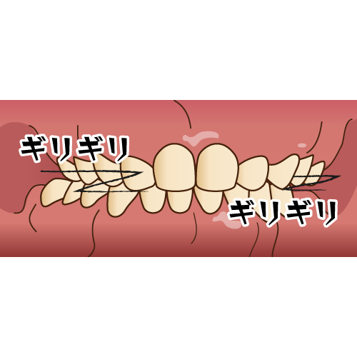 放っておくと危ない！！強い歯ぎしりにはご用心。