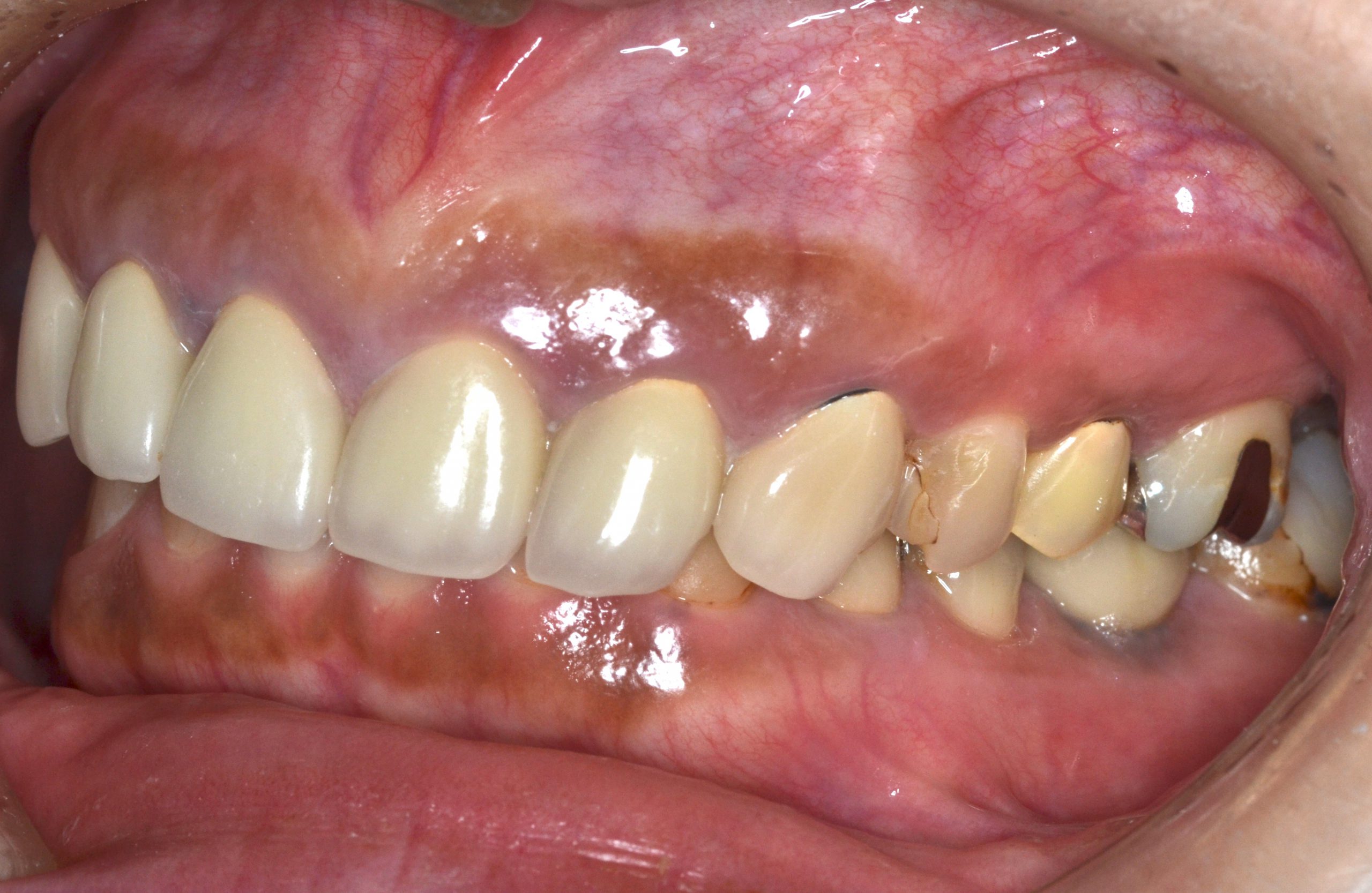 かぶせ物を入れている歯茎が下がって黒ずんでいるのですが治し方はありますか？？