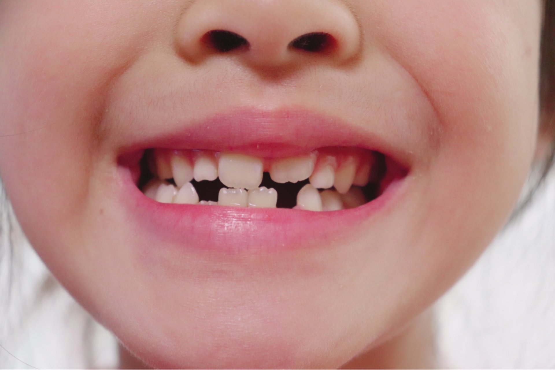 歯の豆知識：過剰歯とは