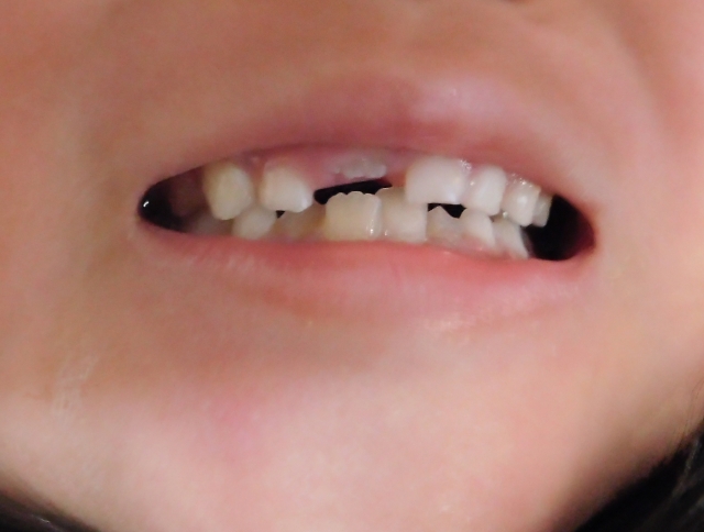 4歳未満で乳歯が抜けたら要注意！実は低フォスファターゼ症とは？？