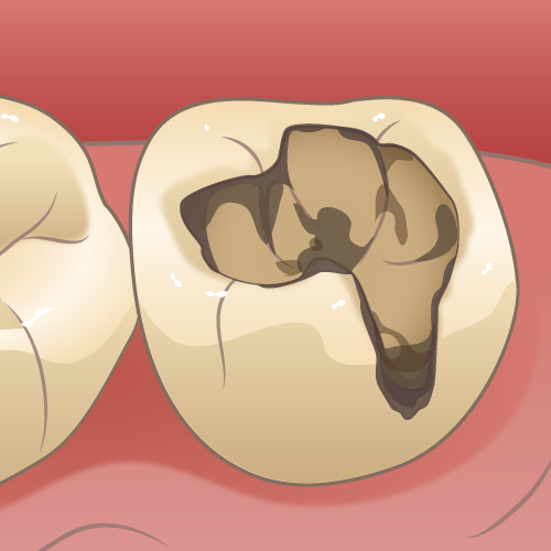 2次カリエス、なぜ1度治療した歯がまた虫歯になるのか？