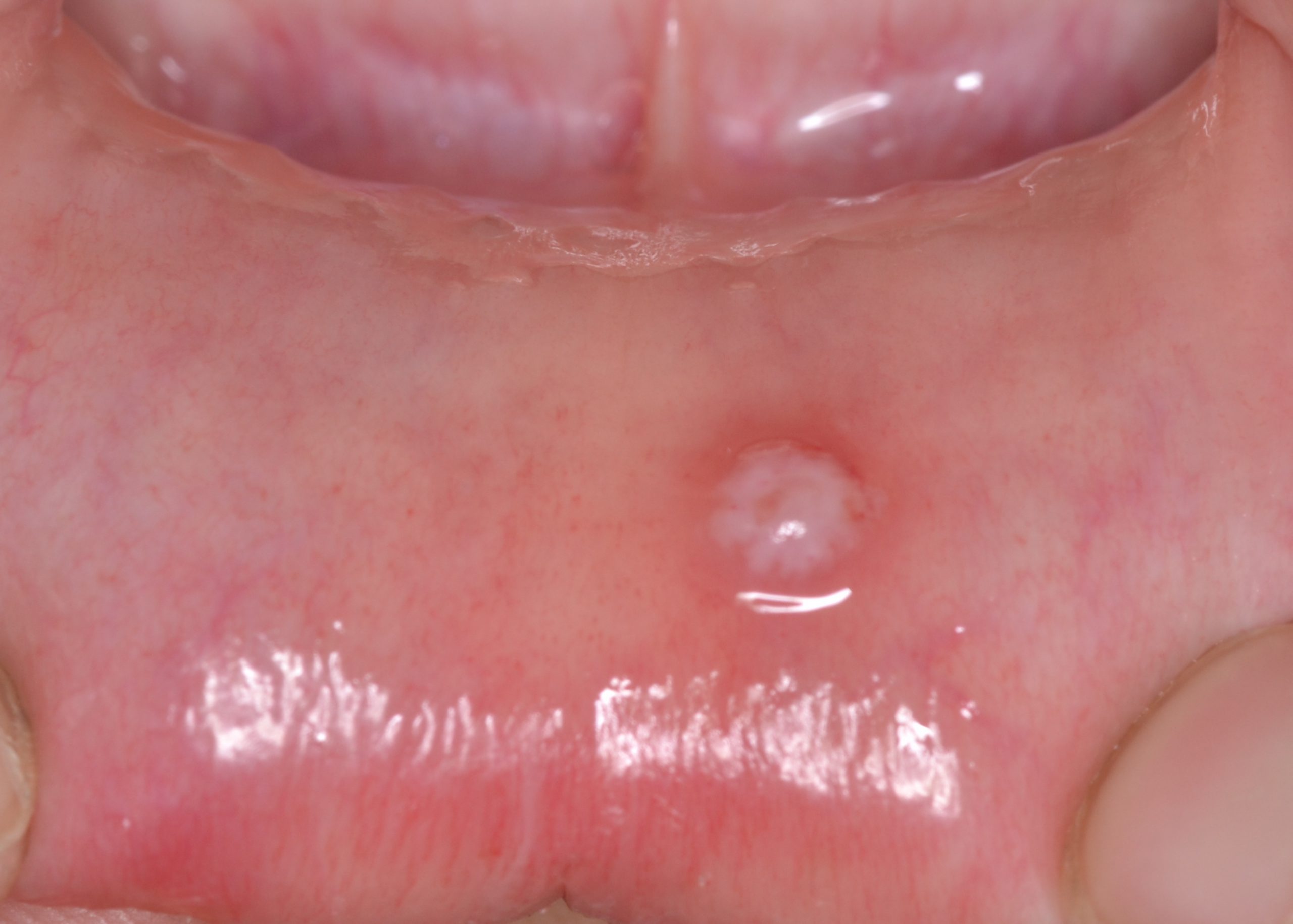 唇にできた口内炎がなかなか治らないと思ったら疑う粘液嚢胞とは？？