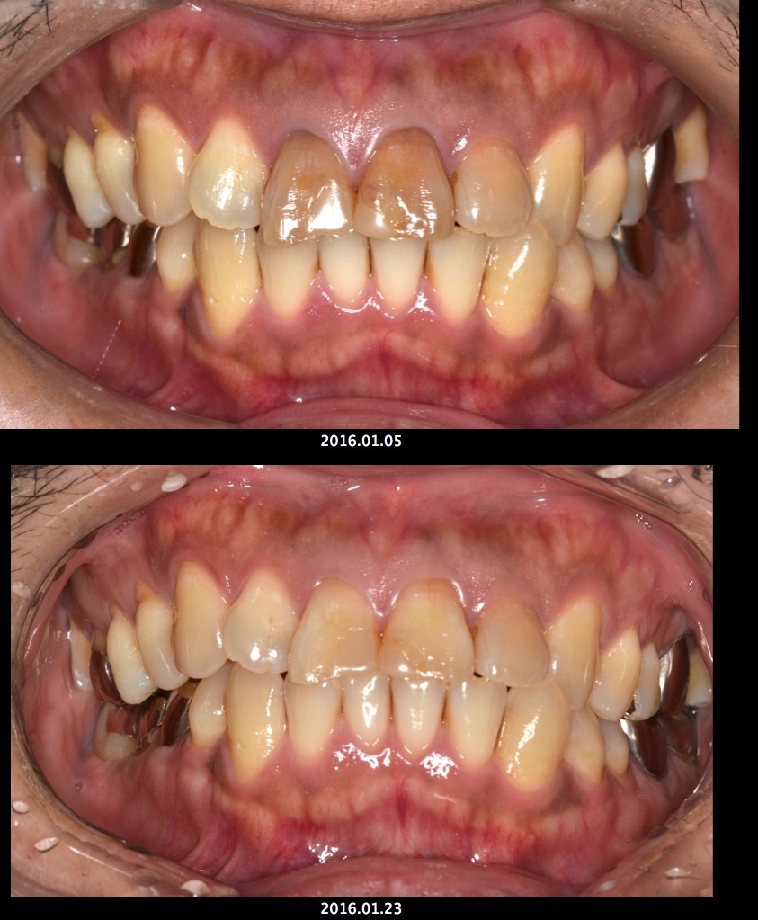 前歯の神経を取った歯の変色を治す方法とは？