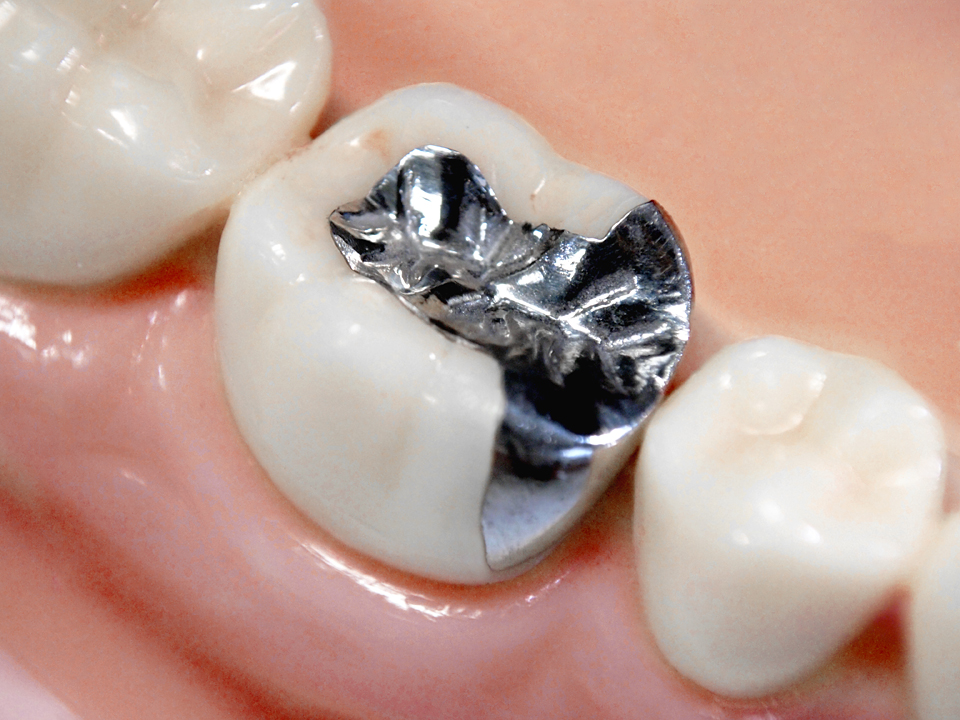 銀歯とセラミックはどっちを選べばいいの？