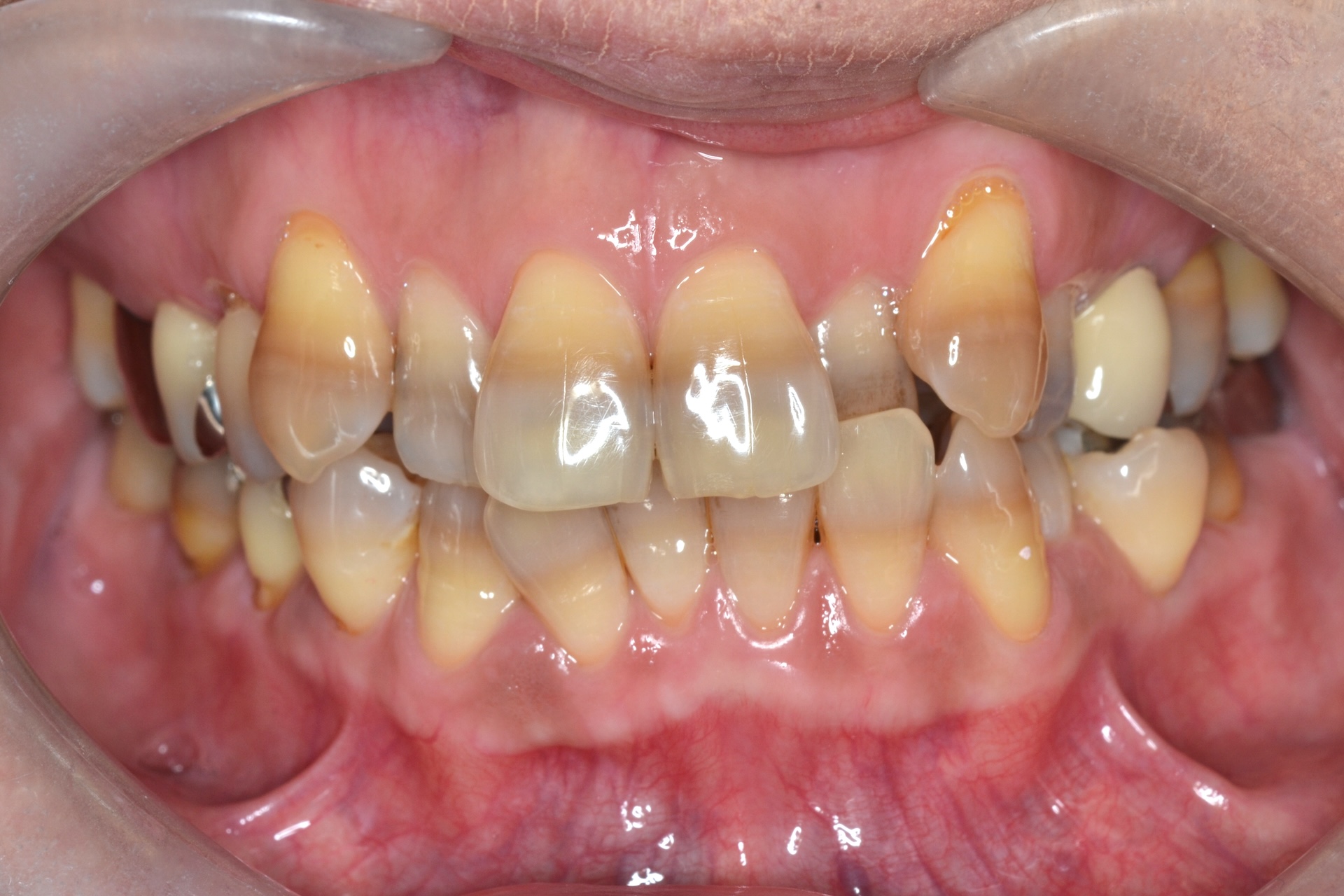 矯正治療をして歯の変色をラミネートベニアで治療した症例