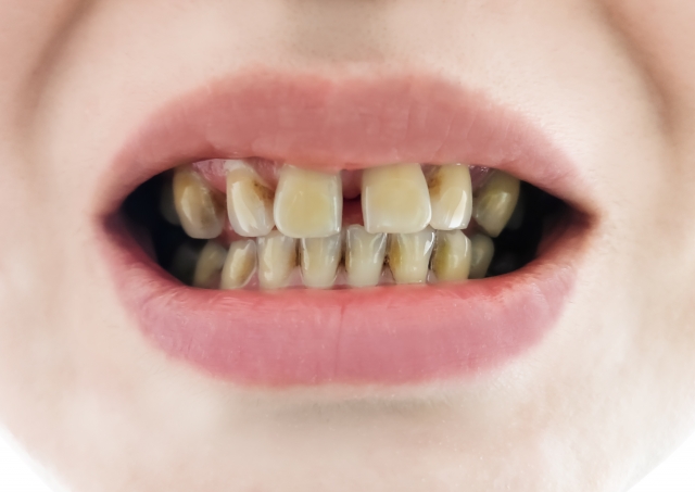 🦷すきっ歯の人必見!歯をほとんど削らずに美しく改善する「ハーフベニア」とは?