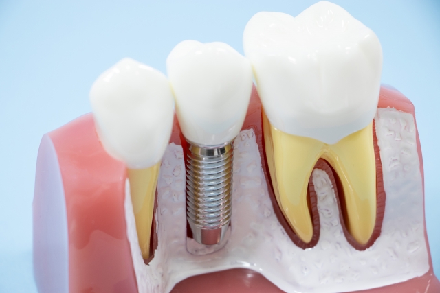 🦷 インプラント治療は「どこで受けるか」で変わる:左京山歯科・矯正歯科クリニックのこだわり