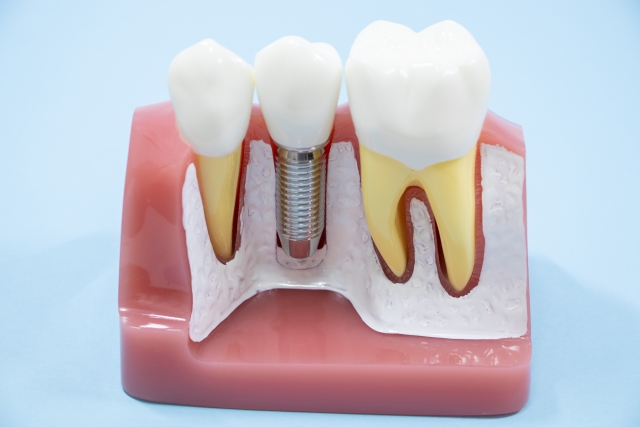 【インプラントが怖い方へ】「実はむし歯治療の方が大変？」院長が語る手術のリアルと鎮静下オペ