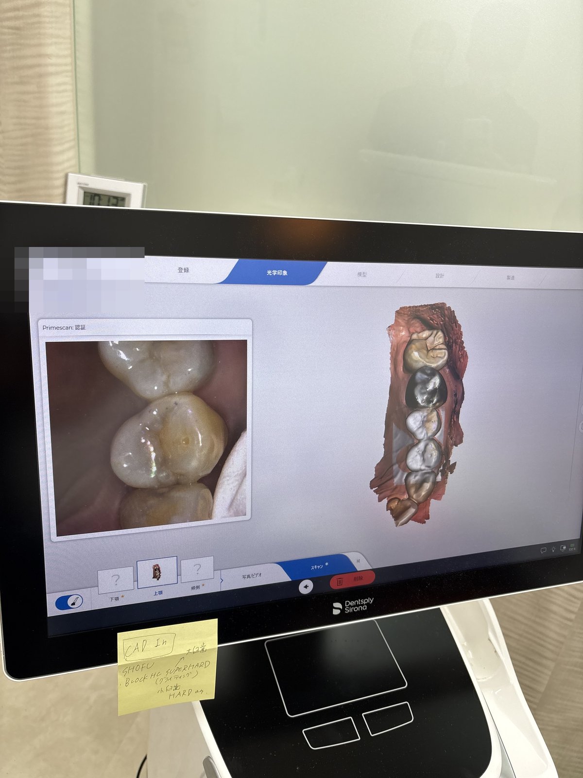 PrimeScanモニターに表示された3D歯型データ