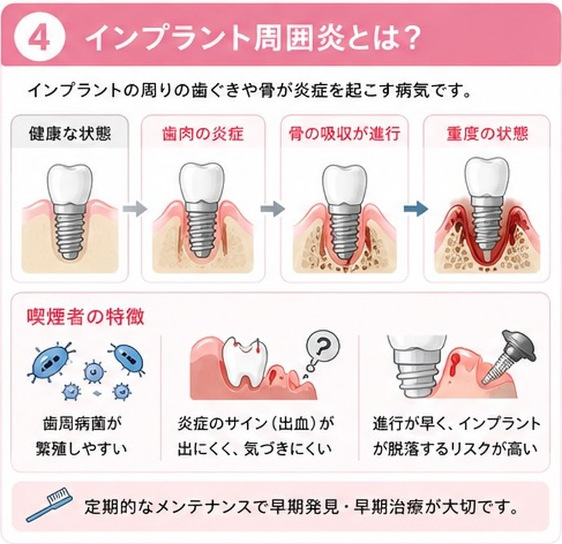 インプラント周囲炎とは?