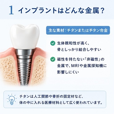 インプラントはどんな金属?