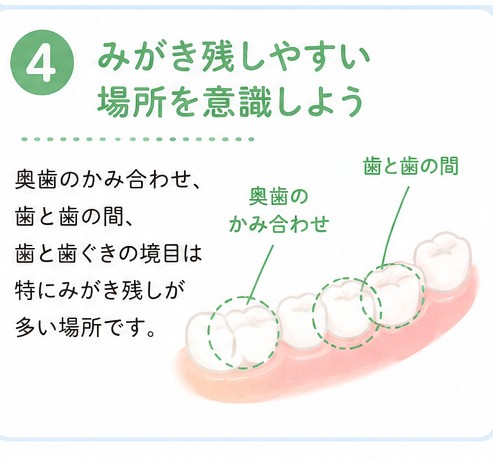 みがき残しやすい場所