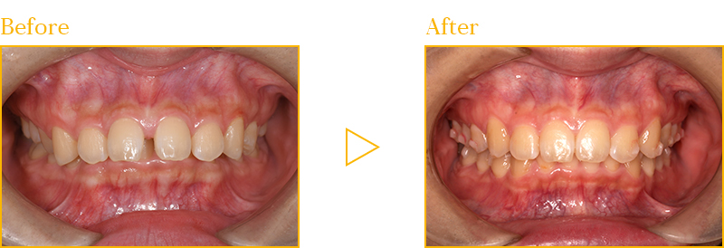 矯正治療による治療例