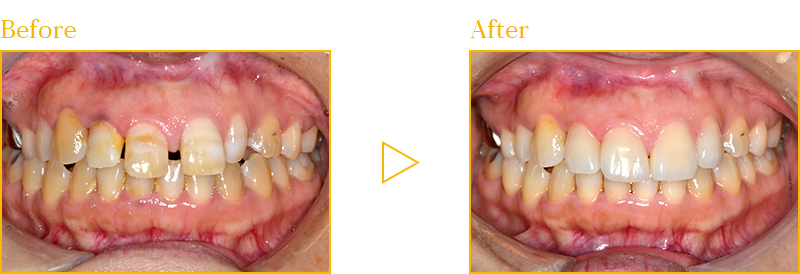 ラミネートべニアによる治療例